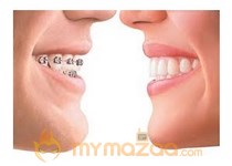 Dental Braces - Types of Dental Braces
