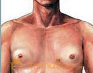 Male Breast Enhancement