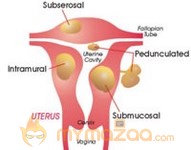 Help for Women With Fibroids