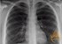 Breath temperature test may help diagnose lung cancer