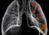 Lung cancer linked to risk of stroke 