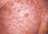 Measles posing outbreak threat in parts of KP 