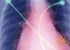 Power of suggestion affects heart arteries