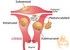 Help for Women With Fibroids