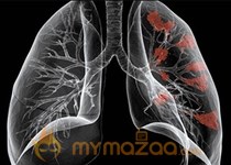 Lung cancer linked to risk of stroke 