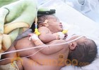 Conjoined twin babies shifted to NICH Karachi 