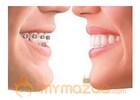 Dental Braces - Types of Dental Braces