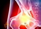 New surgical technique allows for outpatient hip replacement surgery