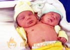 No surgery for now on two-headed baby in Brazil: Doctors 