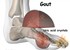 Gout Disease and Natural Remedies for Gout Treatment