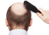 Top Home Remedies To Get Rid Of Baldness